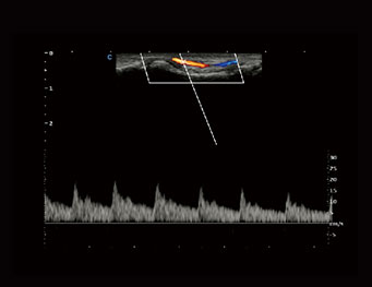 指尖血流，PW 模式