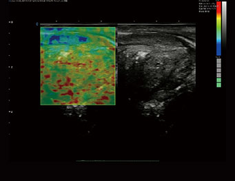 前列腺，弹性成像
