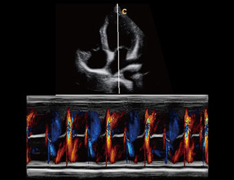 心尖四腔心， 彩色M模式