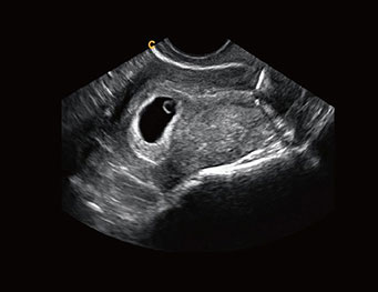 早孕，B 模式