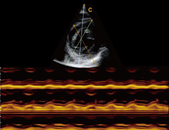 二尖瓣短轴，B 模式