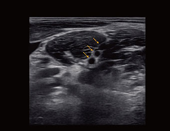 臂丛神经，B 模式
