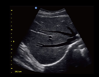 肝脏，B 模式
