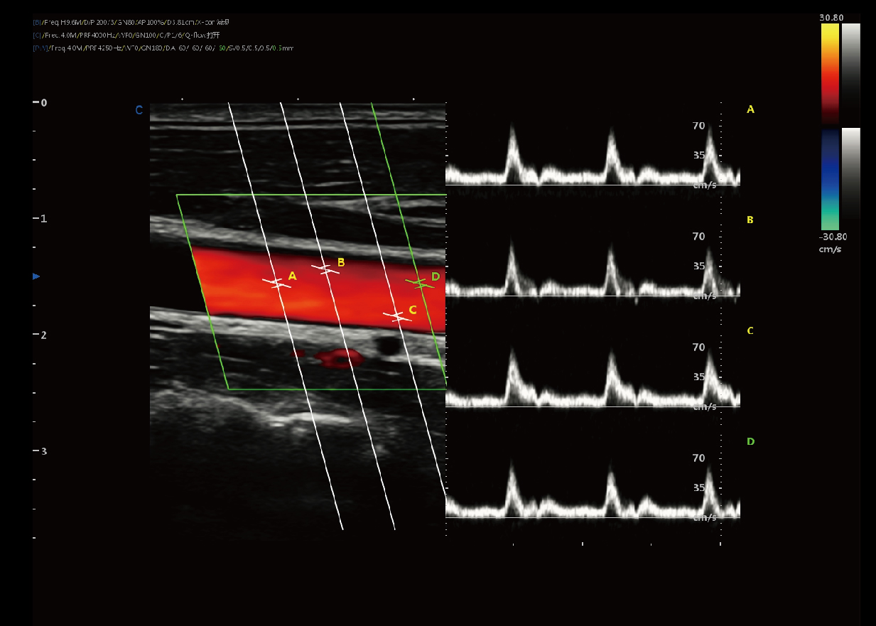 脉冲波多普勒模式