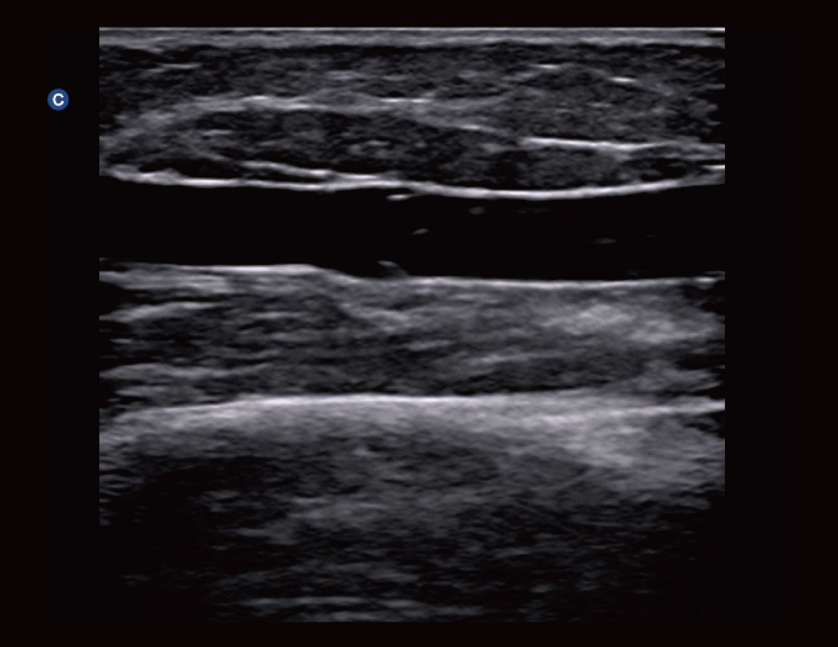 桡静脉瓣，B模式