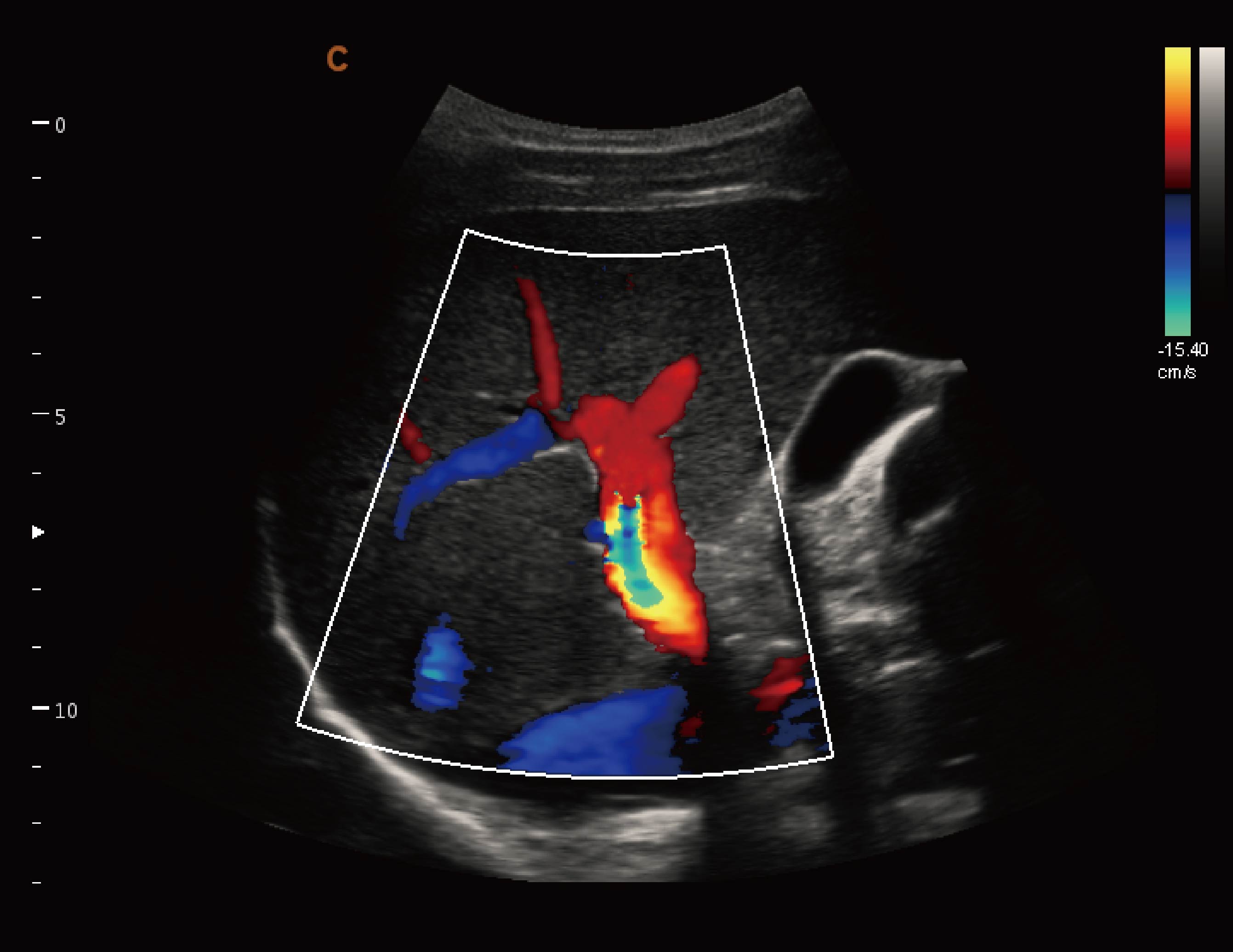 门静脉，C模式