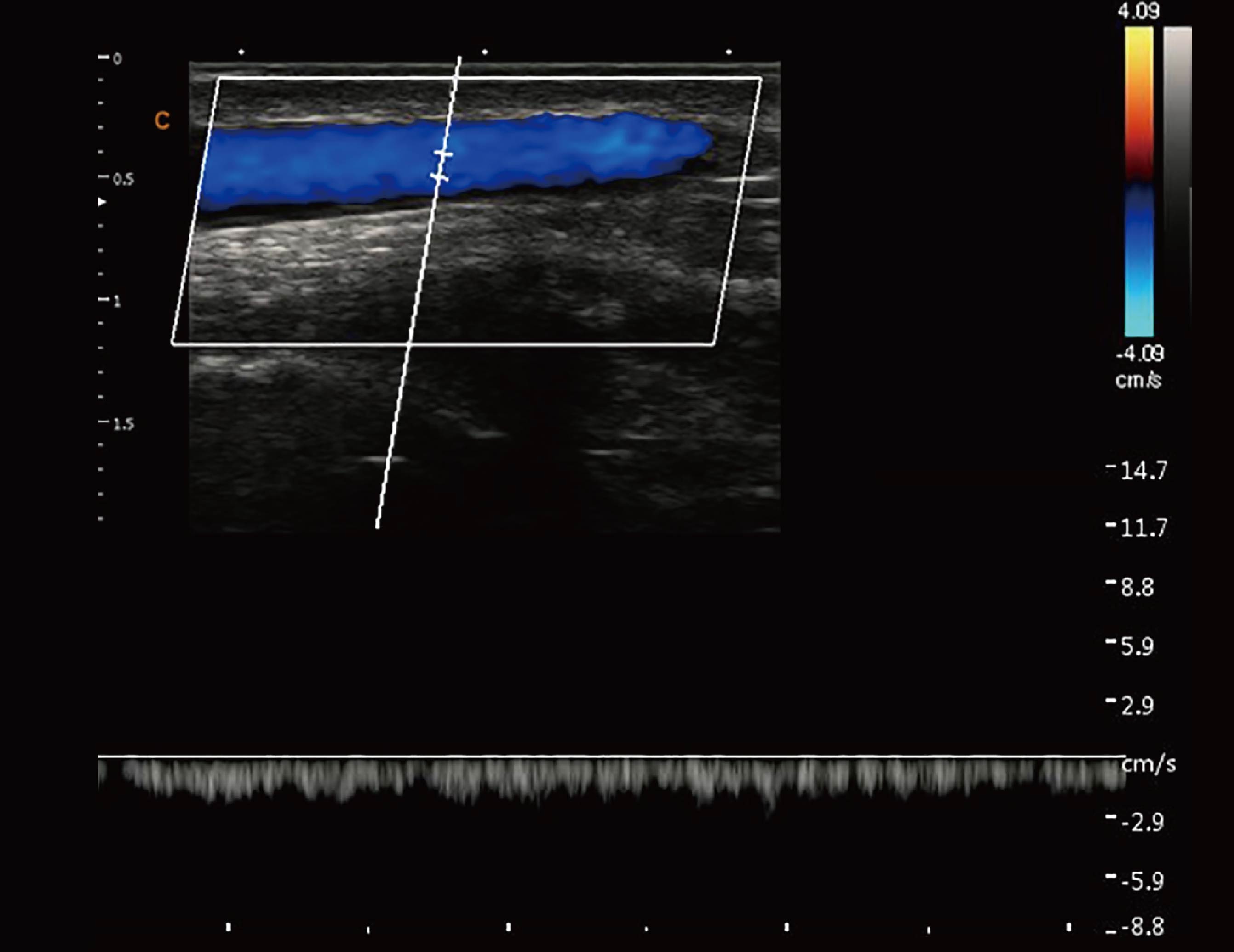 贵要静脉，PW模式