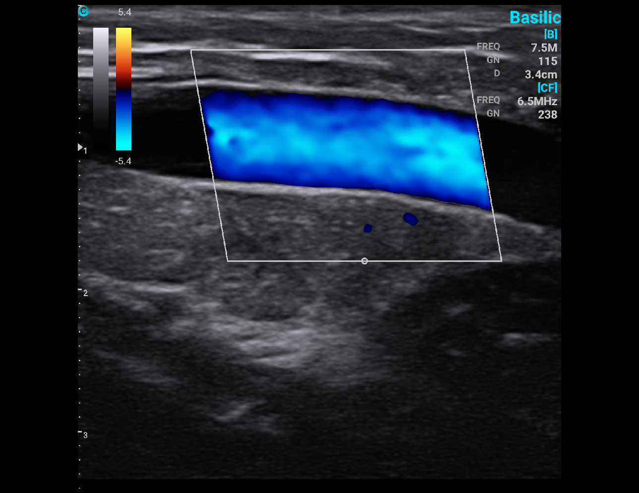 贵要静脉，C 模式