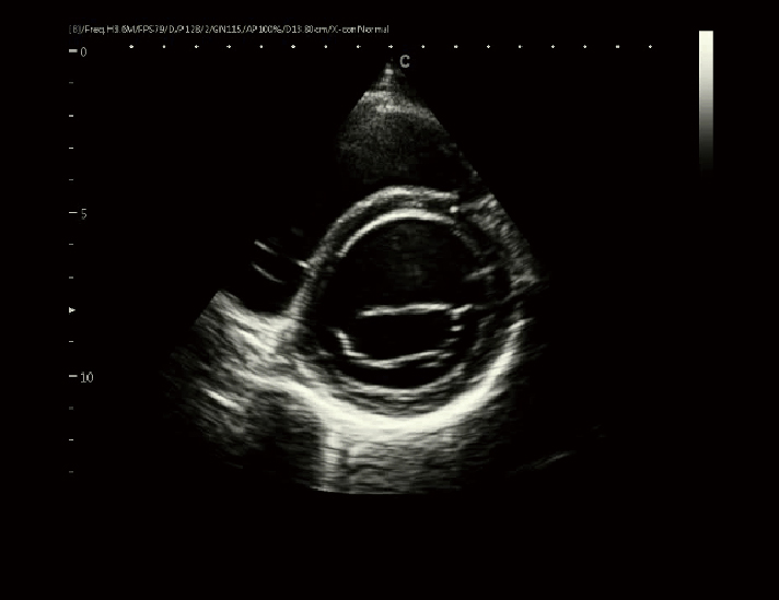 心脏，B模式