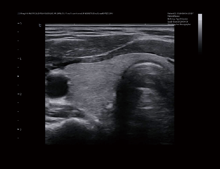 甲状腺，B模式