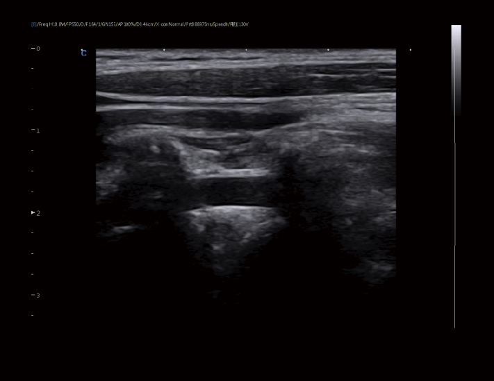 椎动脉，B模式