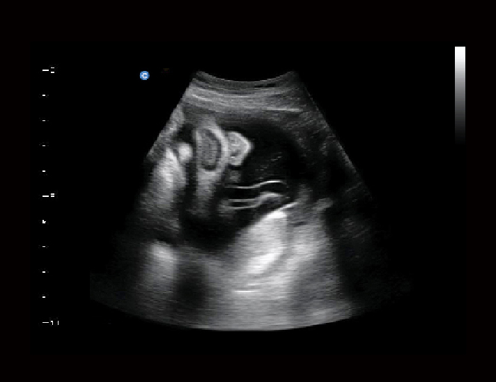 胎儿，B模式