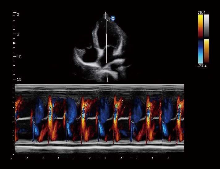 心脏，CM型模式