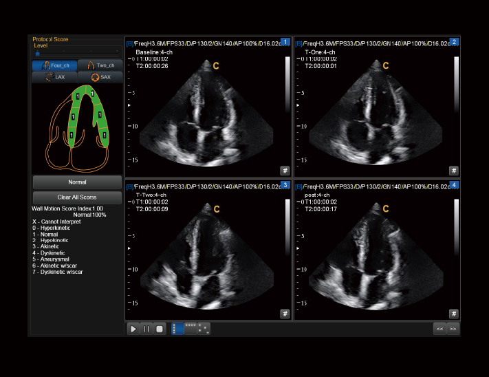 心脏，Stress Echo模式