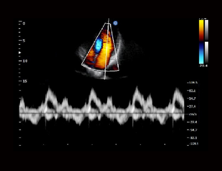 心脏，PW模式