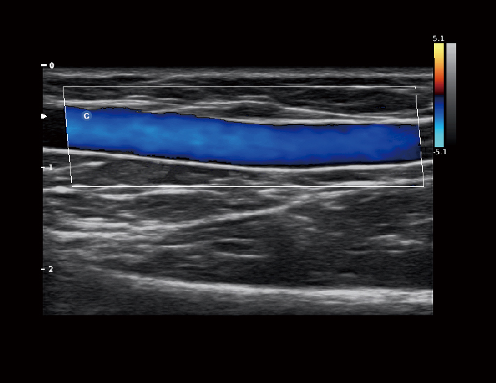 血管，C模式