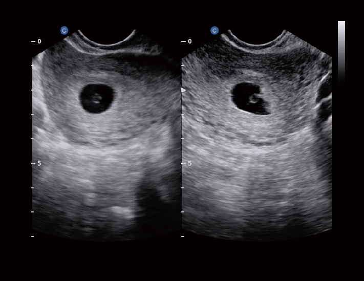 孕囊，B模式