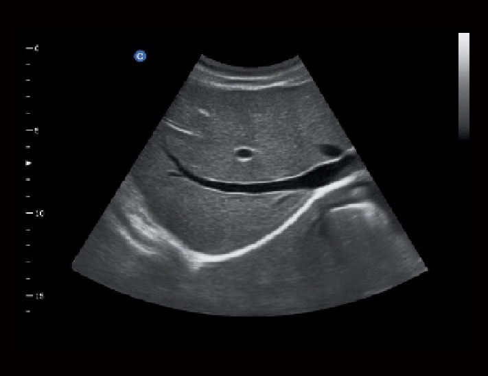 肝脏，B模式