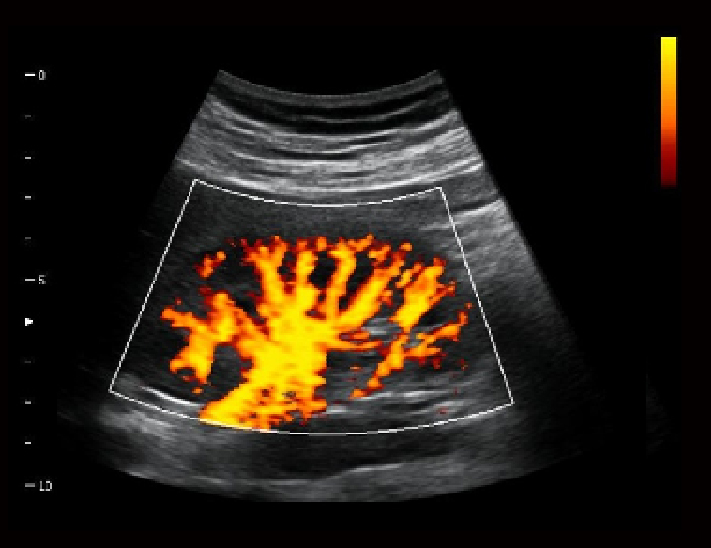 肾脏，MVI模式