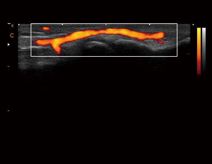 浅表血管，C模式