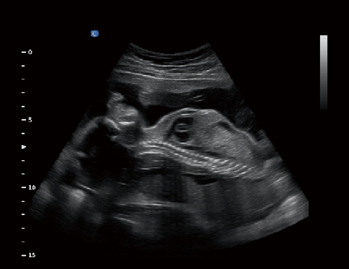 胎儿，B模式
